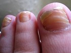 toenail infection